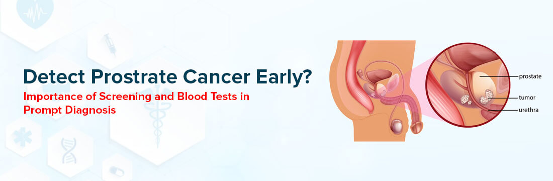 Detect Prostrate Cancer Early? Importance of Screening and Blood Tests In Prompt Diagnosis